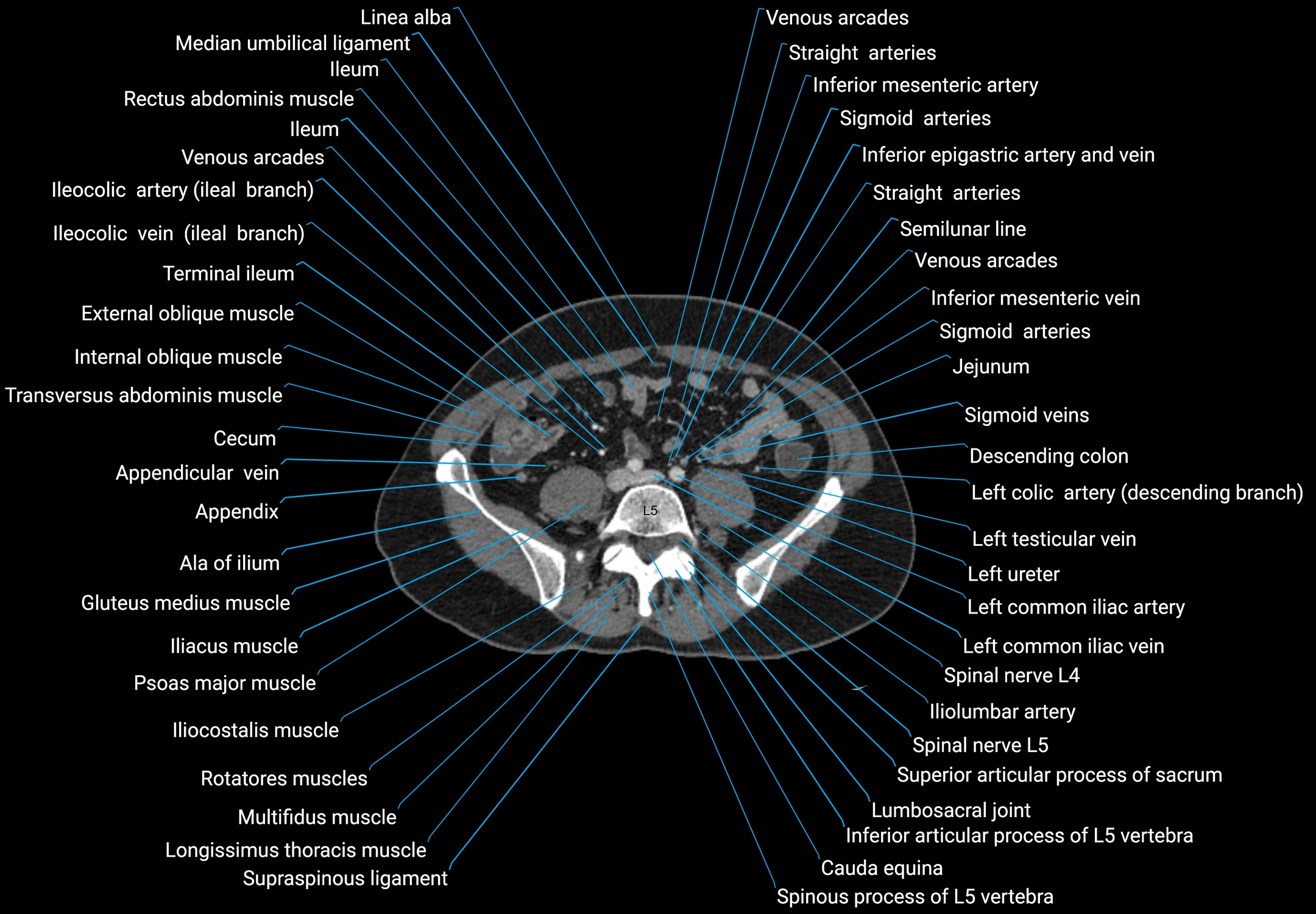 CT male pelvis axial cross sectional anatomy labelled radiology image -00127.webp